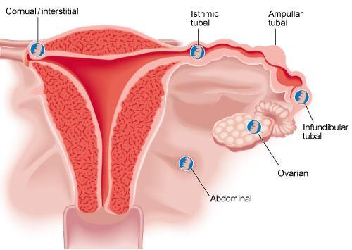 Ectopic pregnancy