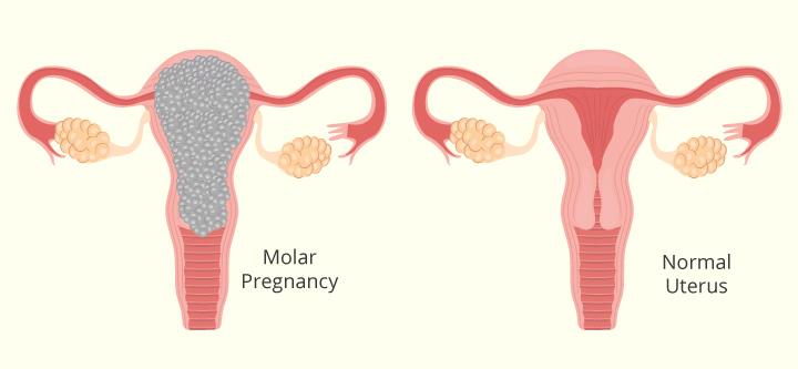 Molar pregnancy