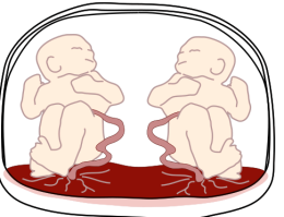 Monoamniotic-Fertilised egg splits later with in 8 – 13 days.