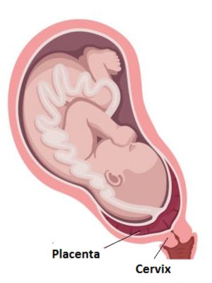 Placenta Praevia (Completely covering the cervix)