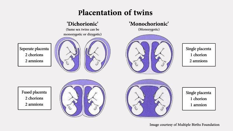 Placentation of Twins