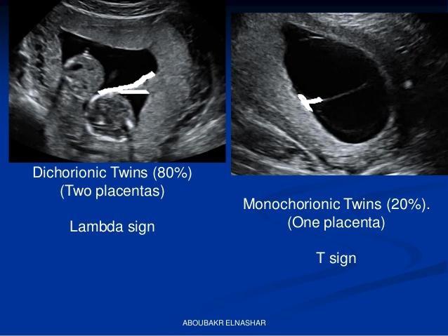 Twin pregnancy and USG