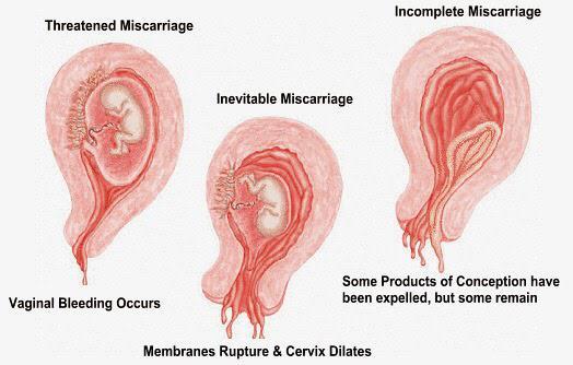 Types of miscarriage