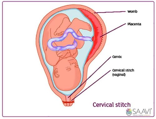 A cervical stitch