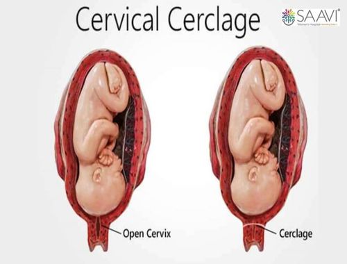 Cervical Cerclage