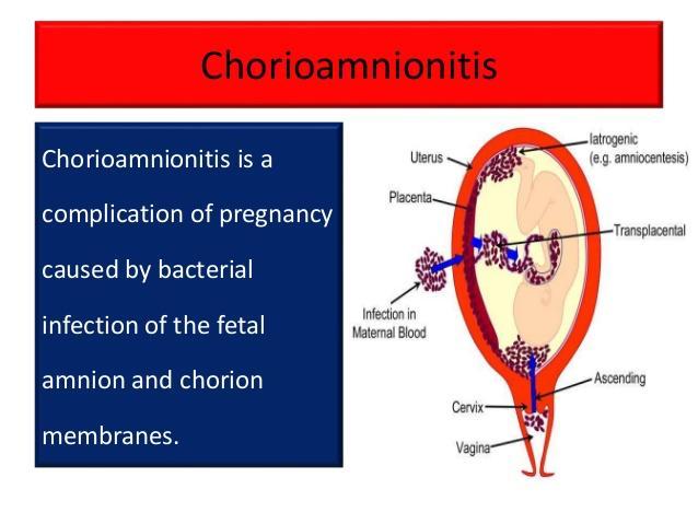 chorioamnionitis