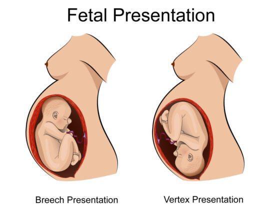 fetal-presentation