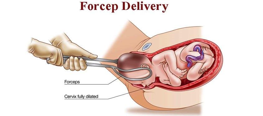 A forceps delivery