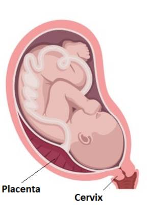 Low-lying Placenta (Less than 20mm from the cervix)