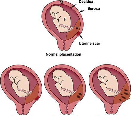 Placenta accrete spectrum