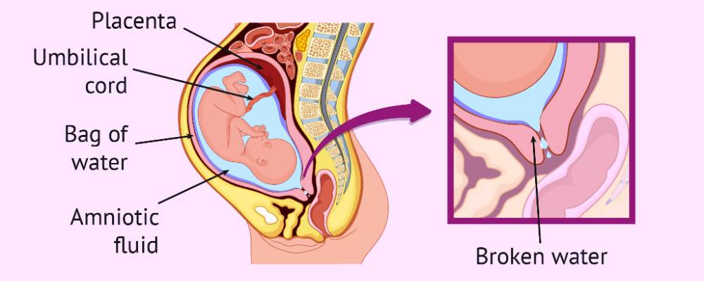 Preterm Prelabour Rupture of Membranes