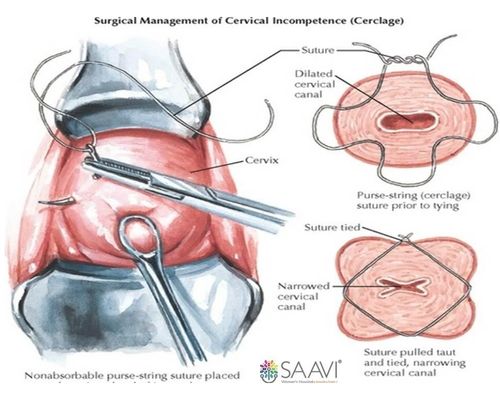 The transvaginal cervical stitch procedure (left) and once it is completed (right)